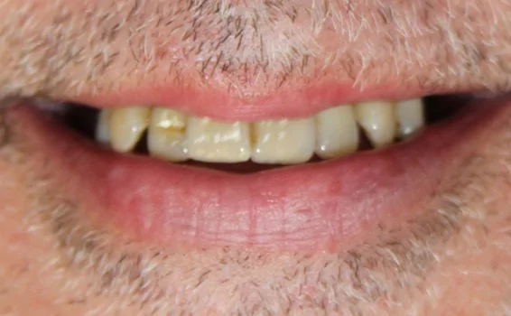 sourire-gilles-avant.jpg sourire-gilles-avant.jpg