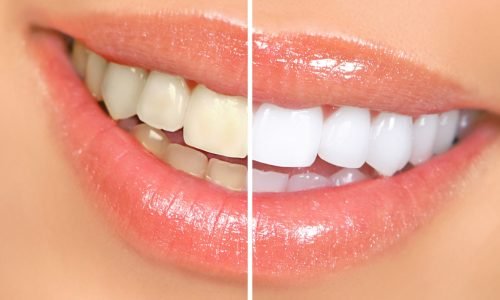 teethwhitening1-1-scaled