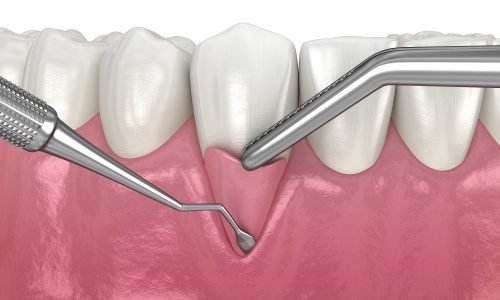 traitement-chirurgical-paro2